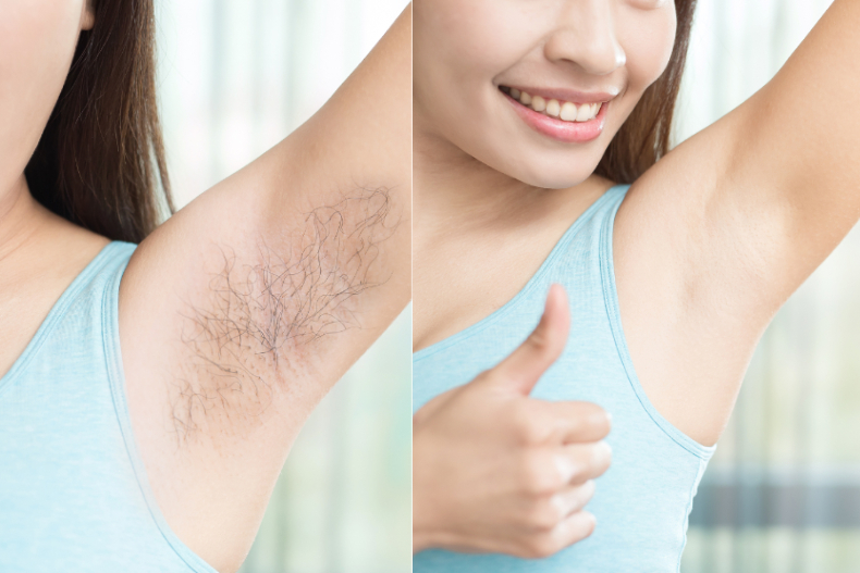 Hướng dẫn triệt lông nách đúng cách, hiệu quả cao